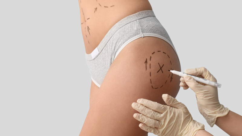 Woman marking surgical procedure area